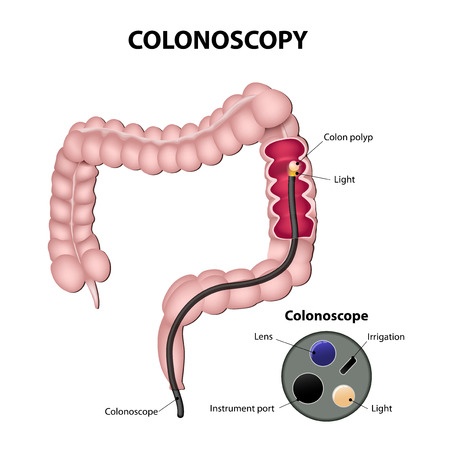 Колоноскопия для диагностики синдрома раздраженного кишечника