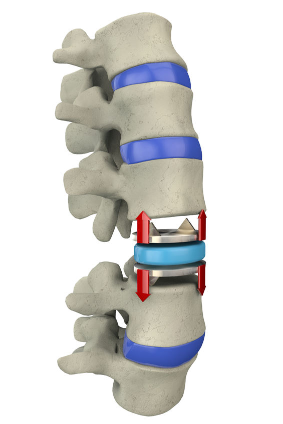 Замена межпозвоночного диска