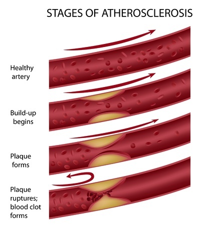 Стадии атеросклероза