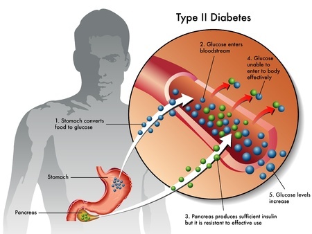 Сахарный диабет 2 типа 