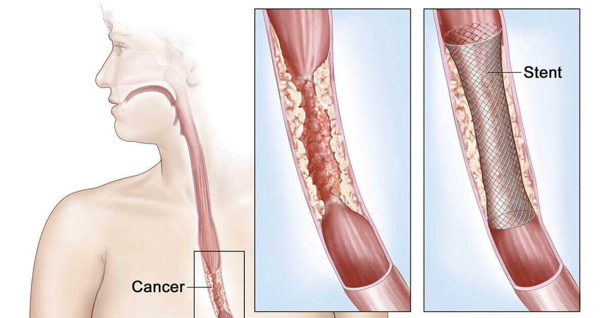 Стентирование рака пищевода и желудка в Израиле