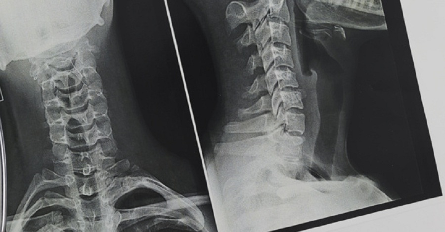 Впервые в «Ихилов»: комплексное выравнивание позвонков шейного отдела