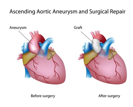 Аневризмой восходящей аорты до и после операции
