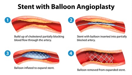 Aнгиопластика и стентирование