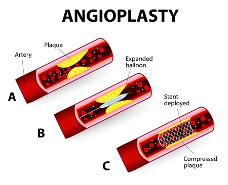 Aнгиопластика и стентирование