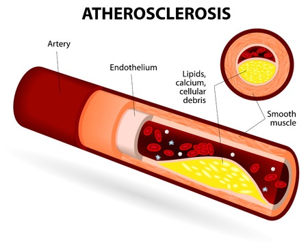 Утолщение стенок артериальных сосудов (атеросклероз)