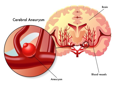 Аневризма сосудов головного мозга