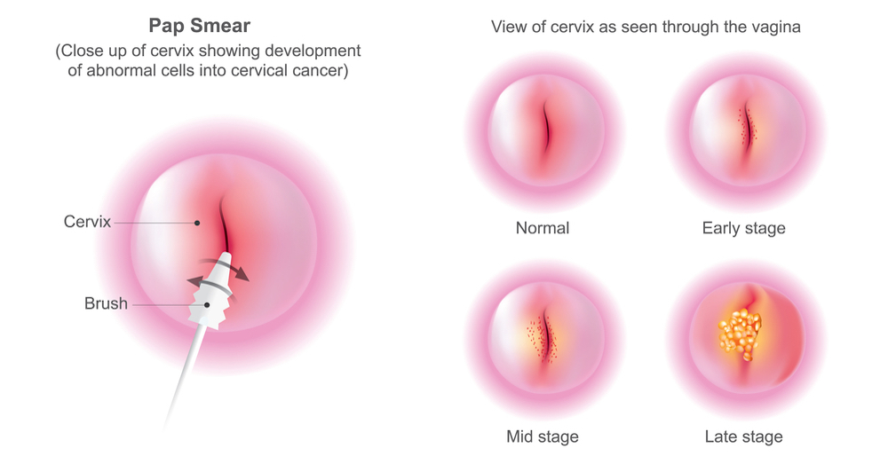 Диагностика рака шейки матки