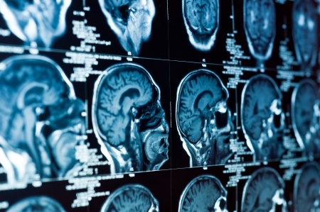 компьютерная томография мозга