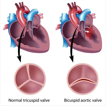 Defective heart valve