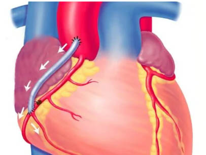 Шунт в обход блокированной артерии