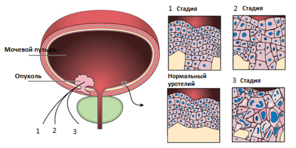 Опухоли мочевого пузыря патогенез. Новообразования мочевого пузыря классификация. Злокачественные новообразования мочевого пузыря классификация. Злокачественная опухоль мочевого пузыря.