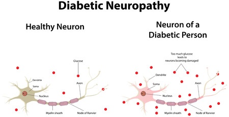 Диабетическая невропатия