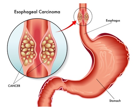Карцинома пищевода