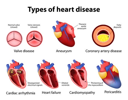 Типы болезни сердца