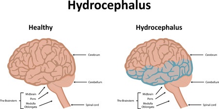 Гидроцефалия головного мозга
