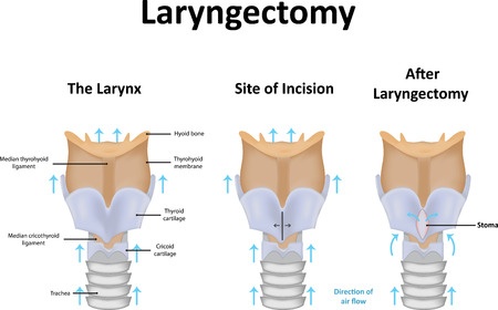 Ларингэктомия