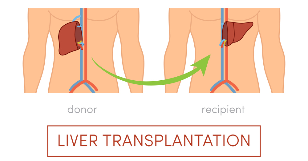 Трансплантация печени