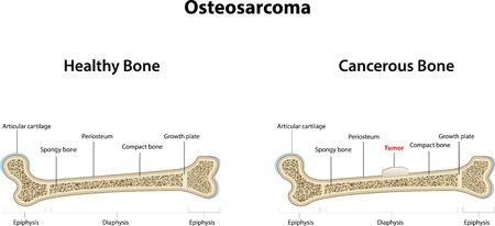 Остеосаркома