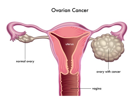 endometrium rák ncbi