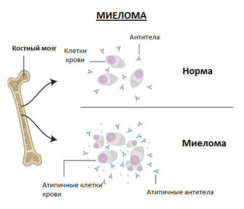 миелома