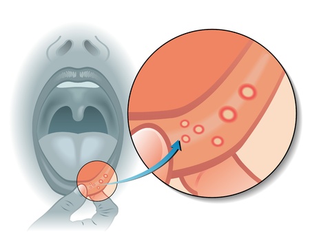 рак губы симптомы