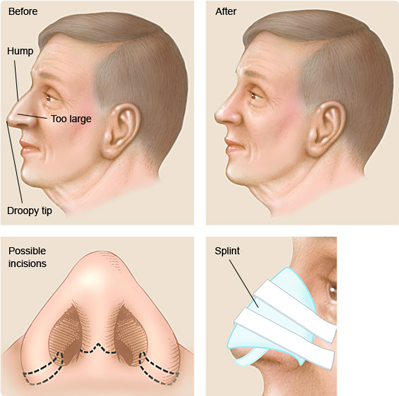 Пластическая хирургия носа
