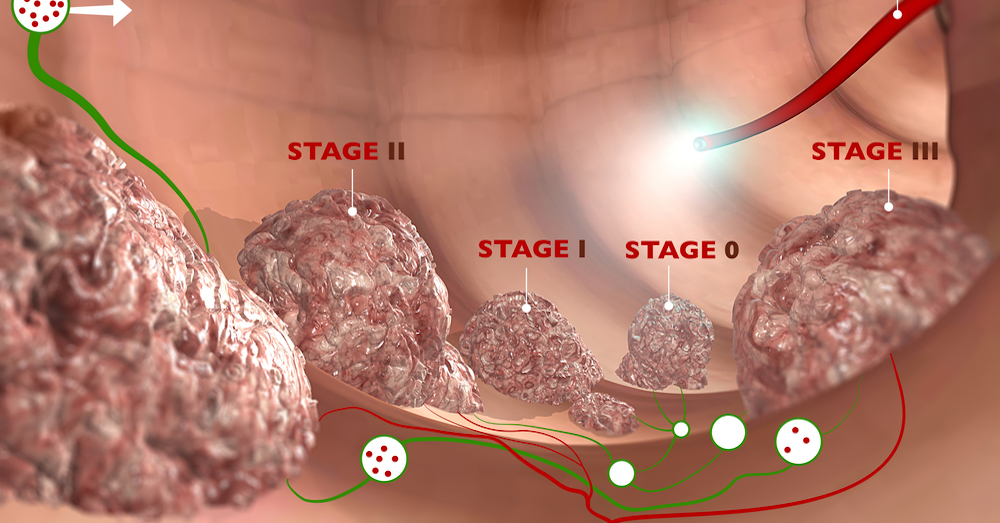 Стадии рака сигмовидной кишки