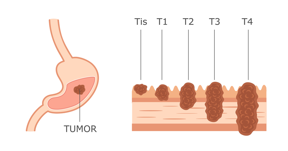 Стадии рака желудка