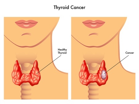 Рак щитовидной железы