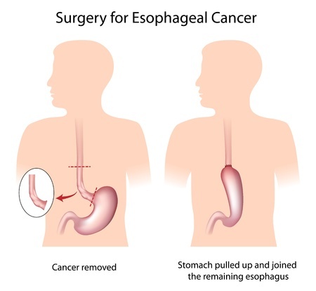 Хирургическое лечение рака пищевода