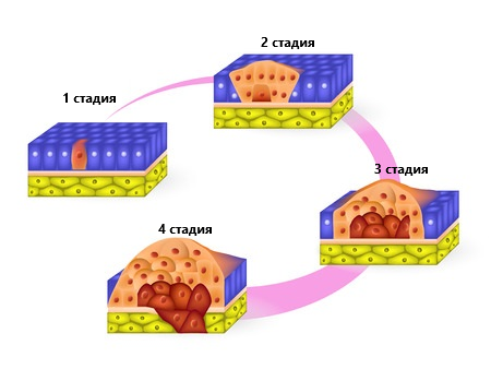 стадии плоскоклеточного рака кожи