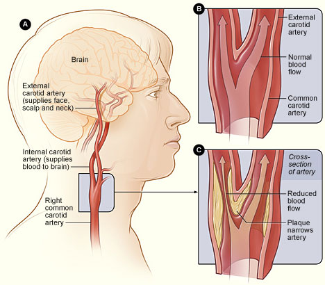 Стеноз каротидной артерии