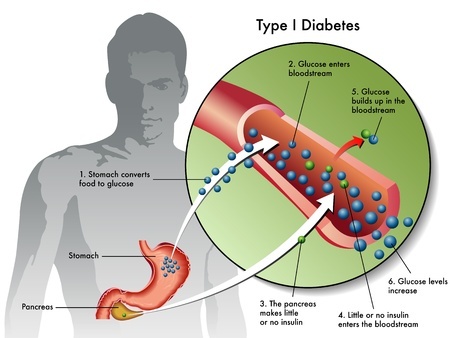 Сахарный диабет 1 типа