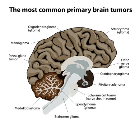 виды опухолей мозга